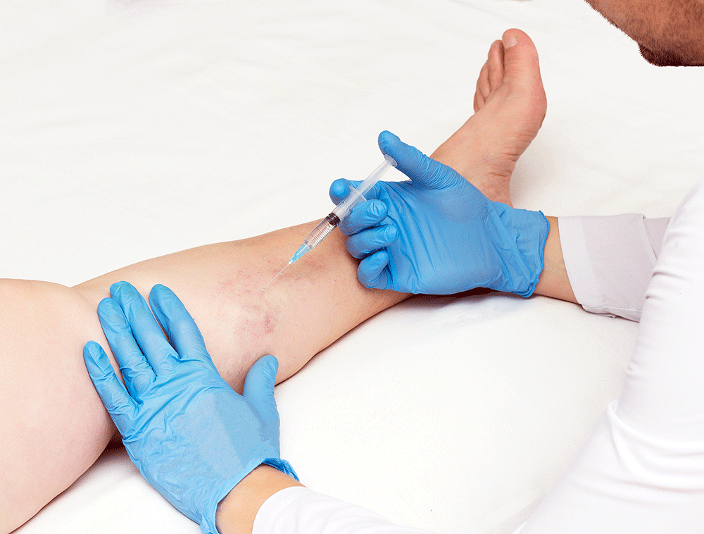 vein-treatment-2