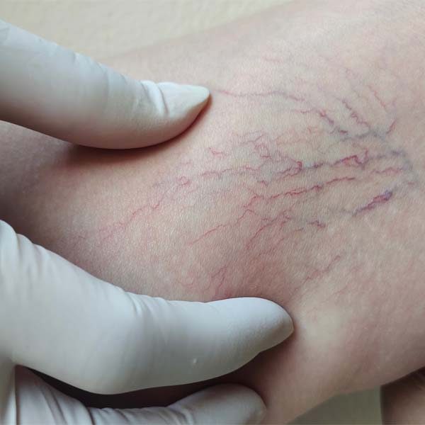 Sclerotherapy Los Angeles