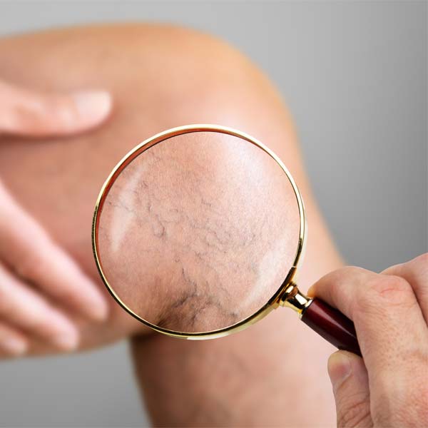 Sclerotherapy Spider Veins Treatment Los Angeles